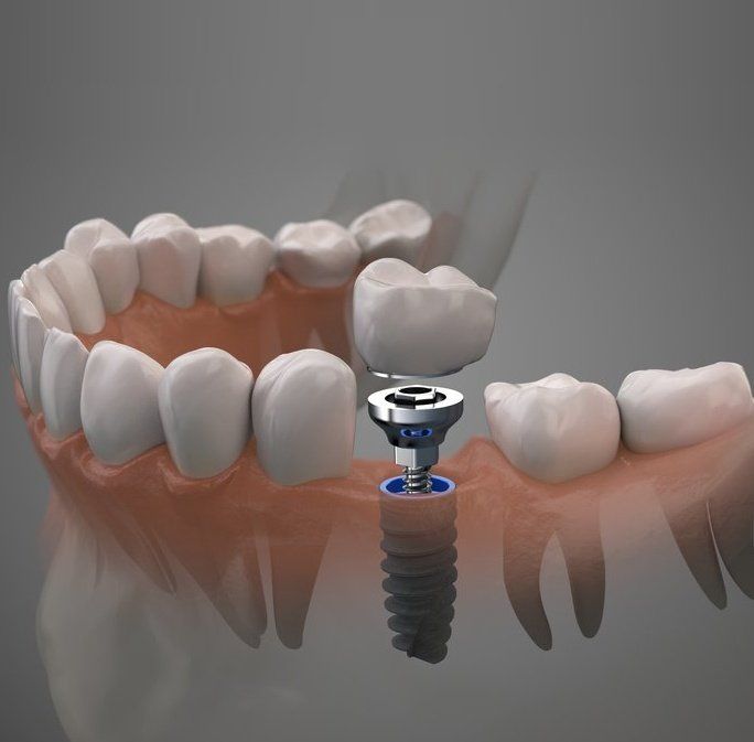 How to Save Money on Full Mouth Dental Implants