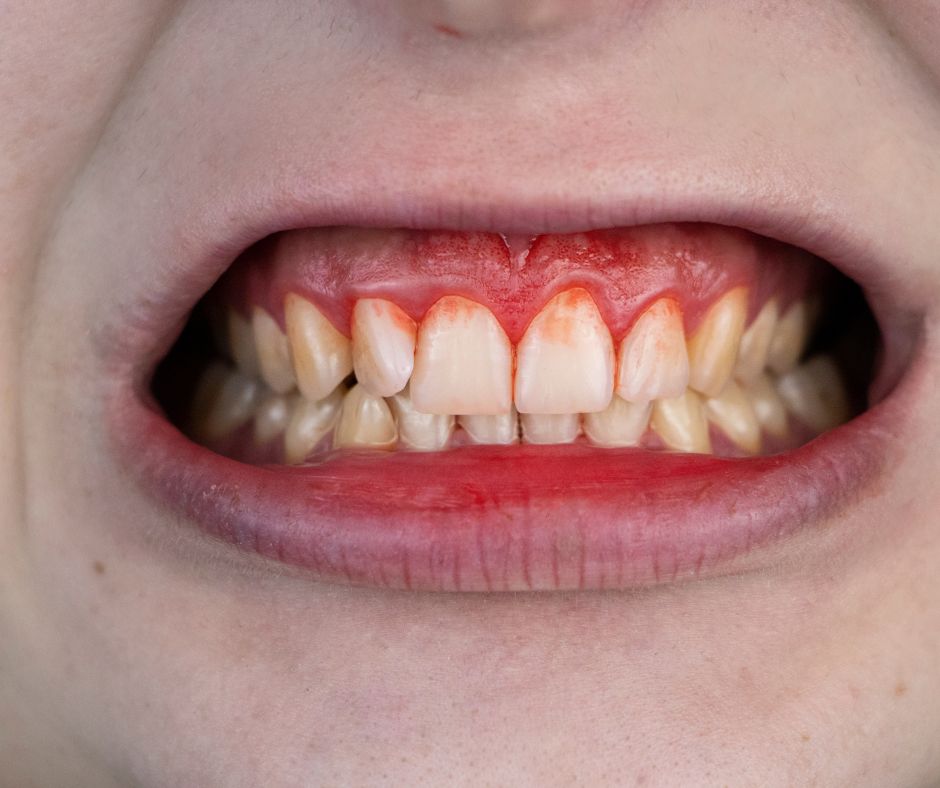 Gum Disease Treatment at Zeal Dentistry