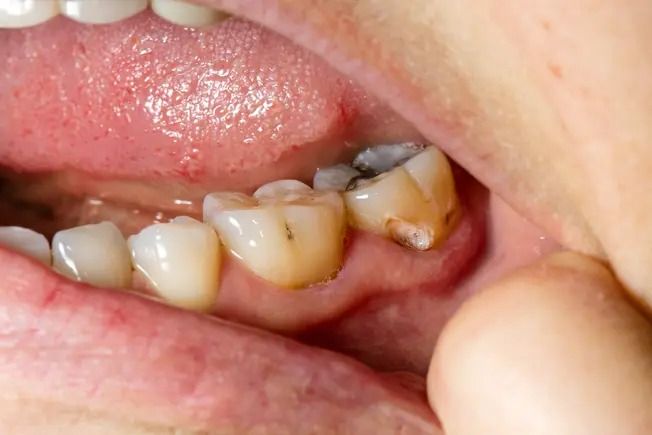 Dental Abscess Treatment