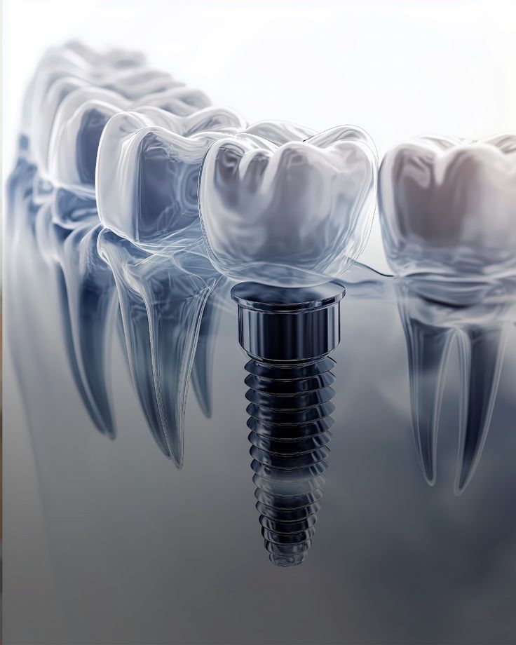 Cost & Comparison of Full Mouth Dental Implants: A Complete Guide