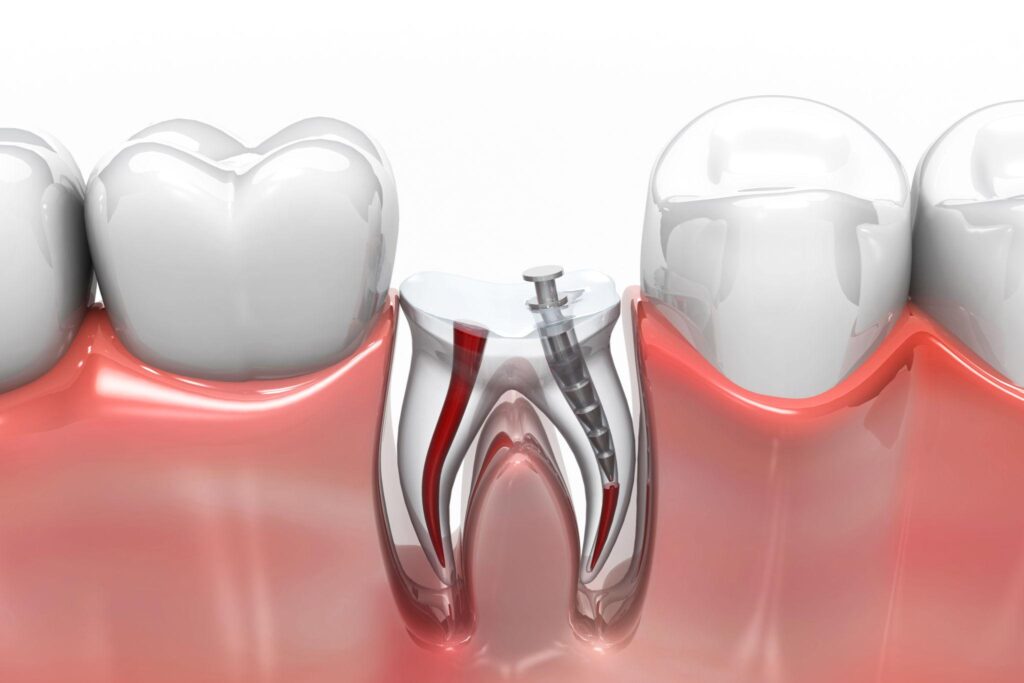 Root canal treatment procedure being performed by a dentist at Zeal N Dentistry