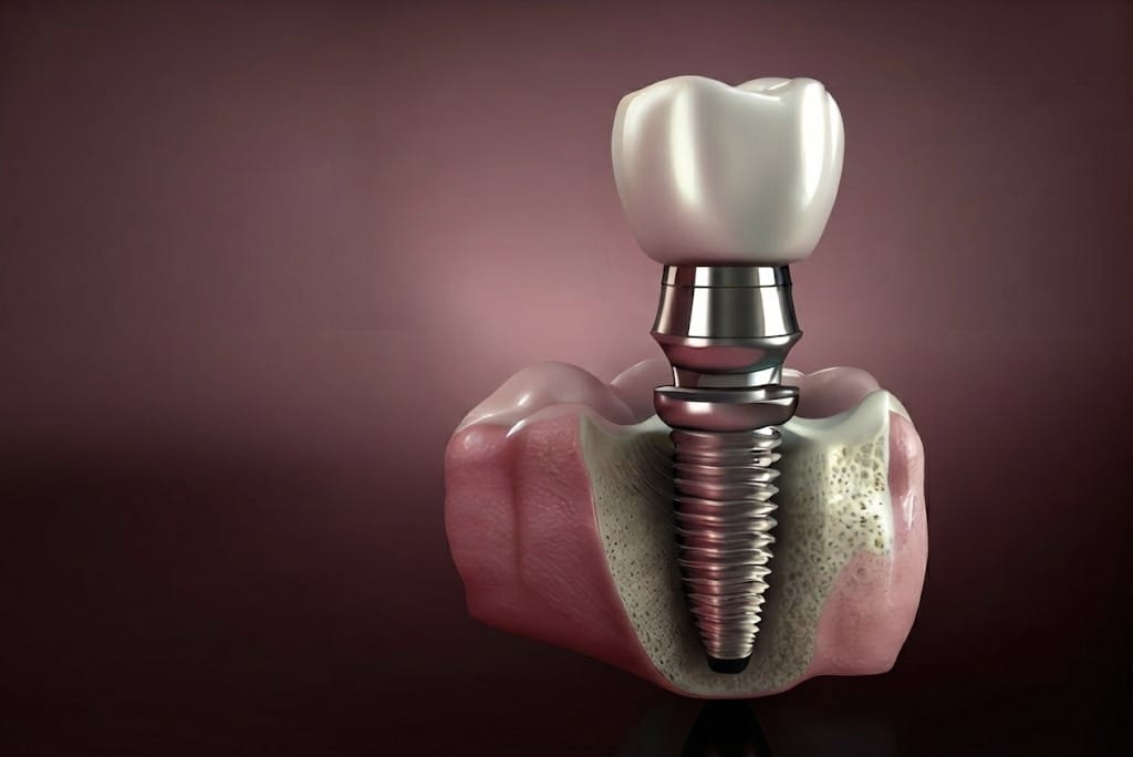 Dental Implants: The Ultimate Guide for a Permanent Smile Solution