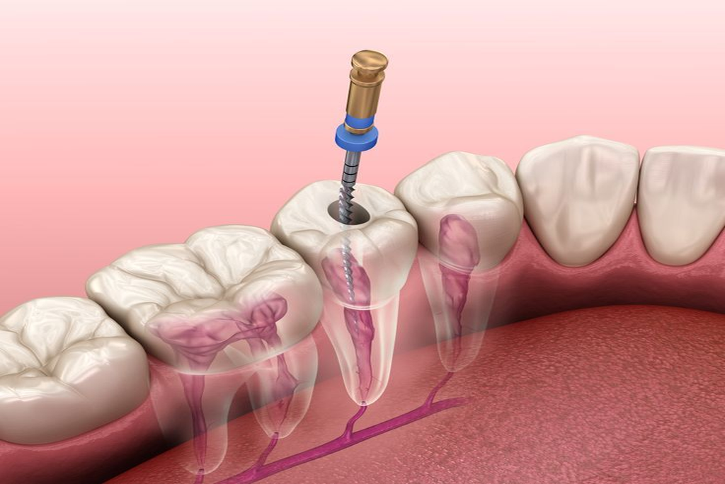 Root Canal Therapy: Rescuing Teeth, Restoring Confidence